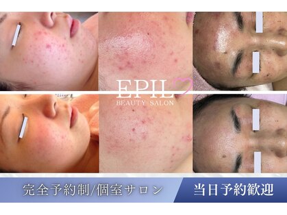 エピル(EPIL)の写真