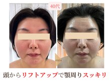 エソア(esoa)/40代　小顔矯正