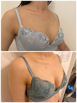 美人バスト 新宿店/☆姉妹店バストアップ症例写真☆