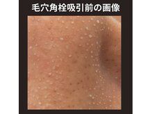ルカシエ(Le Cacie)の雰囲気（毛穴洗浄前に毛穴角栓を浮き上がらせます。酸化皮脂が沢山！）