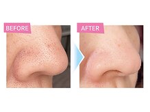 ナルフロウ(nalufurou)/ハイドロスプラッシュ毛穴洗浄