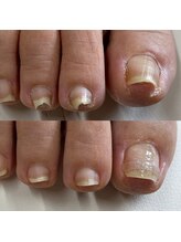 リリ(lili)/フットケア/ネイルスキンケア