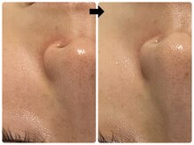 エフェクト 塚口店(effect)/Before After &nbsp;&nbsp;20代/3回目