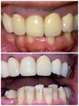 コントレール 歯ぁと(CONTRAIL)/かぶせ物の着色も取れました