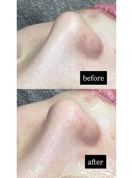 プラスボーテ 幡ヶ谷(plus beaute)/毛穴エクストラクション/渋谷