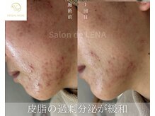 サロンドレナ 名駅店/ハーブピーリング サロンドレナ