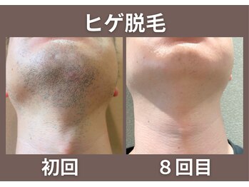 グローアップ(Glow up)/ヒゲ脱毛ビフォーアフター