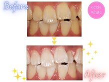 エクシアホワイト 立川南口店/ビフォーアフター