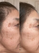 ビー イオンモール小山店(Be...)/肌質改善事例