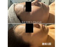 リセル 月島(ReCeLL)の雰囲気（【切らない輪郭ケア】小顔・リフトアップ素肌改善も）