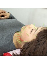 よつば鍼灸整骨院 春日院/美容鍼