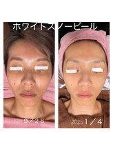 ココ 2号店(CoCo)/ホワイトスノーピール３ヶ月結果