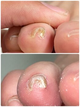 巻き爪じゅん 千葉駅前店/痛みを和らげる丁寧なケア