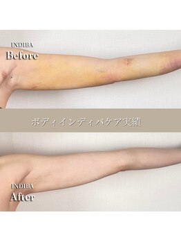 術後の女神 大阪本町店/ダウンタイムケア・インディバ