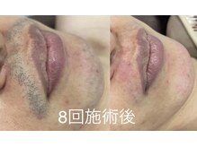 ネフェル(Nefer)の雰囲気（1回目から効果を実感しやすい脱毛機を採用しております！）