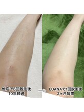 ルアナ(LUANA)/全身脱毛