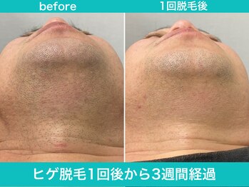 ミスターアンクール 鹿児島(Mr.uncoeur)/ヒゲ脱毛1回後から3週間経過