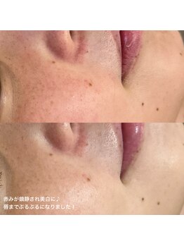 エミュ(e'mu)/韓国アイドル級!プルプル肌♪