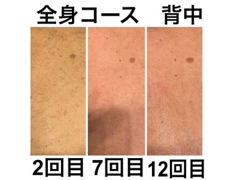 ピノ 西尾店(PINO)/【メンズ脱毛】背中/全身脱毛