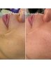 【ほうれい線にアプローチ】 フェイシャルプロセルセラピーズ体験