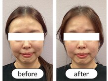 オリガミ鍼灸接骨院 旭丘院/【Before/After】小顔美容鍼