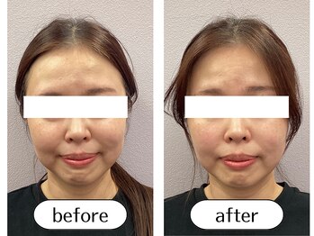 オリガミ鍼灸接骨院 旭丘院/【Before/After】小顔美容鍼