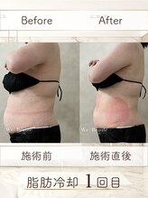 ウィボーテ(We Beaute)/【痩身】脂肪冷却×脂肪分解