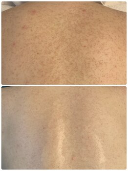 サロン エム(Salon M)/背中のハーブピーリング