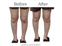 プランツ(PLANTS)/１回／年齢膝ケア・筋膜リリース