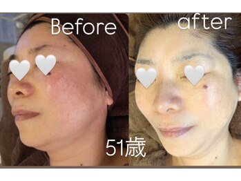ヒーリングサロン イチマルイチ(101)/シミ改善ケアコース 効果