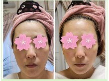 キミーエステティックサロン(kimmy esthetic salon)/リフトアップコース