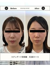 シナジープラス 水前寺店(SYNERGY+)/スタンダード美容鍼 月2回コース