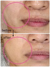 ラ メール ヴィーヴル/たるみケア