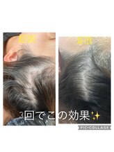 パールブルー(All Perl blue)/キュラハの頭皮改善