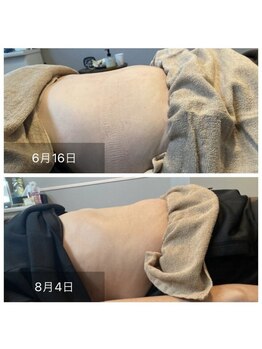 アピアランスビューティー 表参道店/お腹のビフォー/アフター