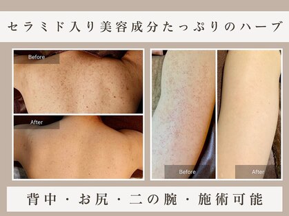 ハーブピーリング専門ハーブ屋【ハーブピーリング/小顔/シミケア/毛穴洗浄】の写真