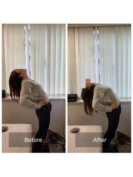 ナオル整体 新宿院(NAORU整体)/30代女性-猫背矯正Before/After