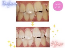 エクシアホワイトニング 西条店/ビフォーアフター
