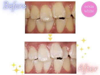 エクシアホワイトニング 西条店/ビフォーアフター