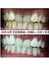 ホワイト 福岡天神店(WHITE)/ホワイトニングビフォーアフター