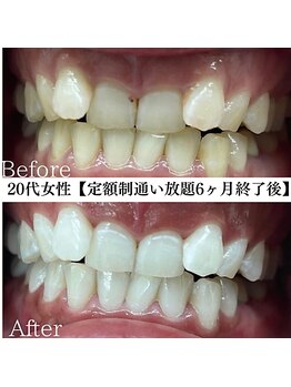 ホワイト 福岡天神店(WHITE)/ホワイトニングビフォーアフター