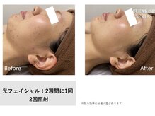 【フェイシャル/脱毛】fu-ra by ANGLERS/リフトアップ