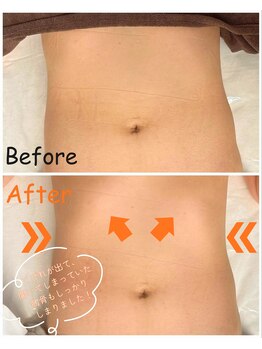 スリモア(SLIMORE)/ビフォーアフター☆お腹