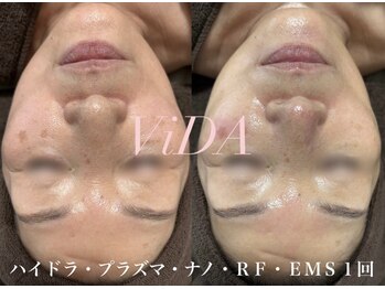 ヴィーダ 渋谷松濤(ViDA)/ハイドラシャイン高出力プラズマ