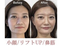 ラプリボヤージュ 藤沢店(Raplit)/ エイジレス隆鼻＋輪郭矯正40分