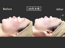 リオ(Rio)/【脂肪コントロール】１回施術