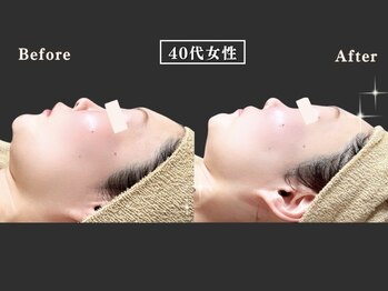 リオ(Rio)/【脂肪コントロール】1回施術