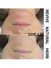 プレイス 堂山本店(PLACE)/ハーブピーリング