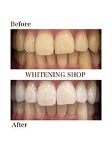 ホワイトニングショップ 岸和田店/お客様のBefore  After