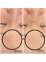 ラシック(Rachic)/肌質改善ハーブピーリング